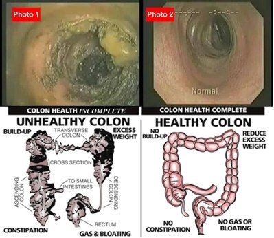 Colon Hydrotherapy Closed System