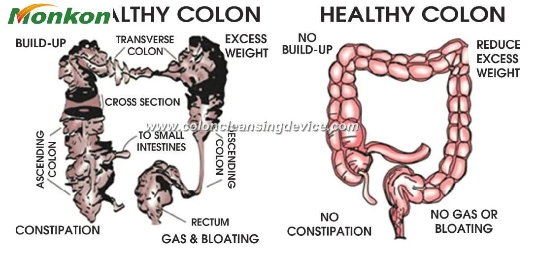 Colon Cleanse Solutions for U.S. Wellness Centers: Practical Choices, Clinic Requirements, and Exact Questions to Ask Suppliers — máquinas de colon, equipos de hidroterapia de colon (267).JPG